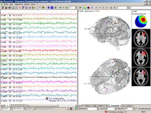 Томография компонент ICA разложения (23 kb)